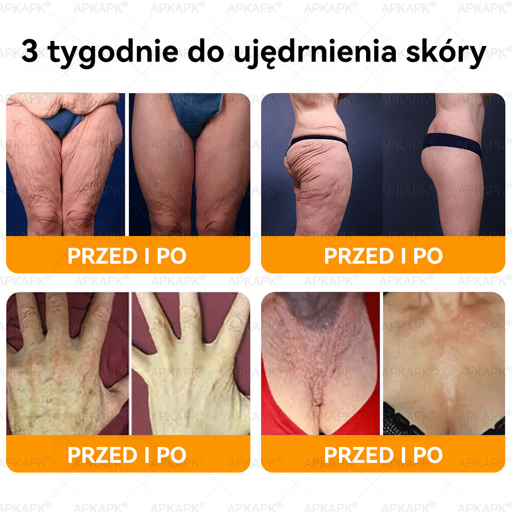 𝖠𝖯𝖪𝖠𝖯𝖪® 𝗕𝗲𝗲 𝗩𝗲𝗻𝗼𝗺 𝗞𝗿𝗲𝗺 𝗻𝗮 𝗼𝗯𝗻𝗼𝘄𝗲𝗻𝗶𝗲 𝗸𝗼𝘇𝗵𝘆🐝pomaga w leczeniu problemów skórnych, takich jak: zmarszczki, blizny, plamy pigmentacyjne, rozstępy, trądzik, łuszczyca, egzema, zmiany skórne, podrażnienia, stany zapalne i inne problemy skórne