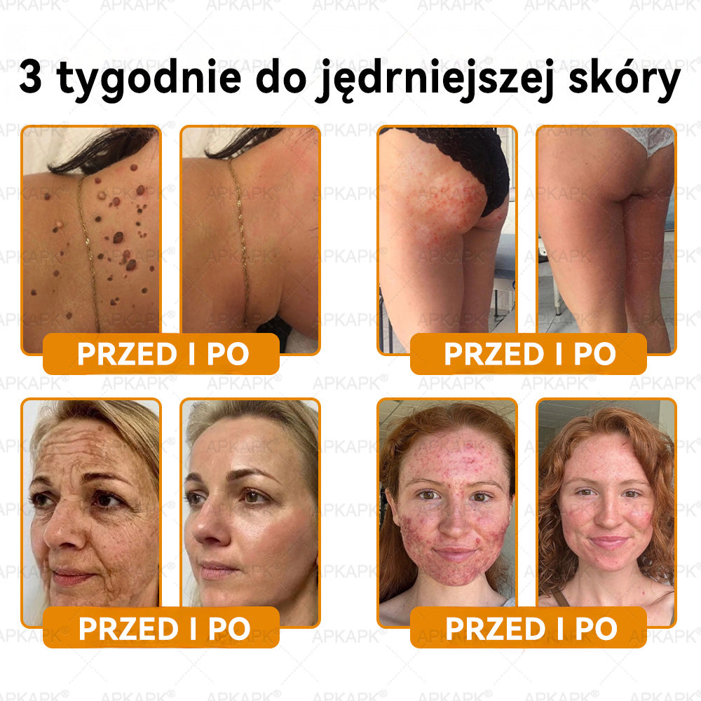 𝖠𝖯𝖪𝖠𝖯𝖪® 𝗕𝗲𝗲 𝗩𝗲𝗻𝗼𝗺 𝗞𝗿𝗲𝗺 𝗻𝗮 𝗼𝗯𝗻𝗼𝘄𝗲𝗻𝗶𝗲 𝗸𝗼𝘇𝗵𝘆🐝pomaga w leczeniu problemów skórnych, takich jak: zmarszczki, blizny, plamy pigmentacyjne, rozstępy, trądzik, łuszczyca, egzema, zmiany skórne, podrażnienia, stany zapalne i inne problemy skórne